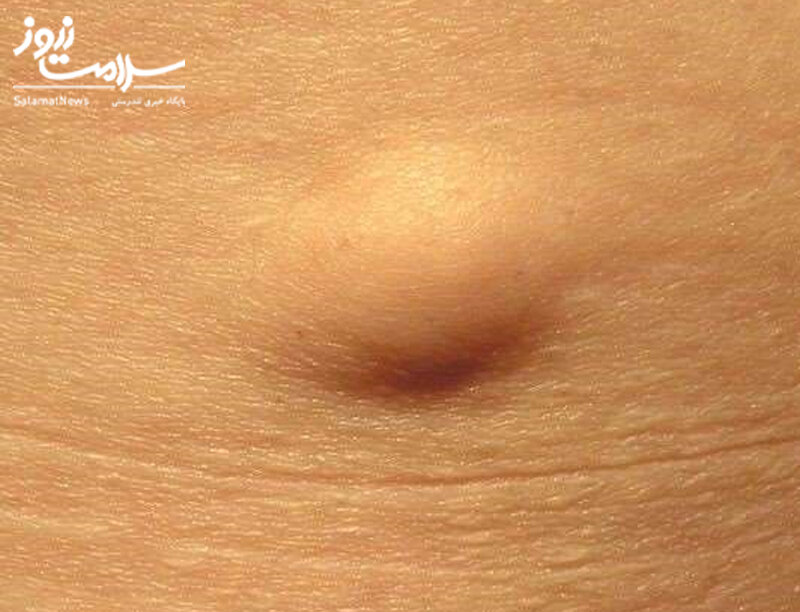 علائم هشدار دهنده «بیماری کلیوی» که روی پوست ظاهر می‌شوند/ این نشانه‌ها را جدی بگیرید