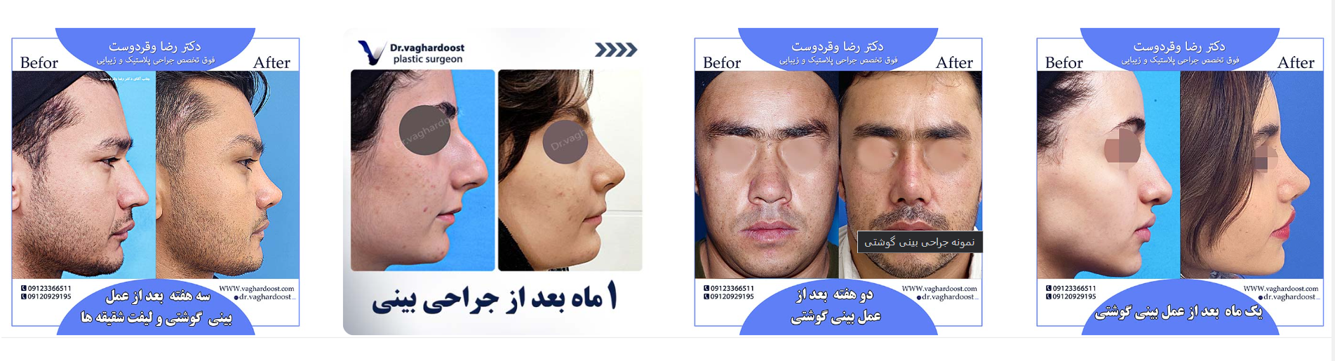 جراحی بینی/ همه چیز درباره عمل بینی