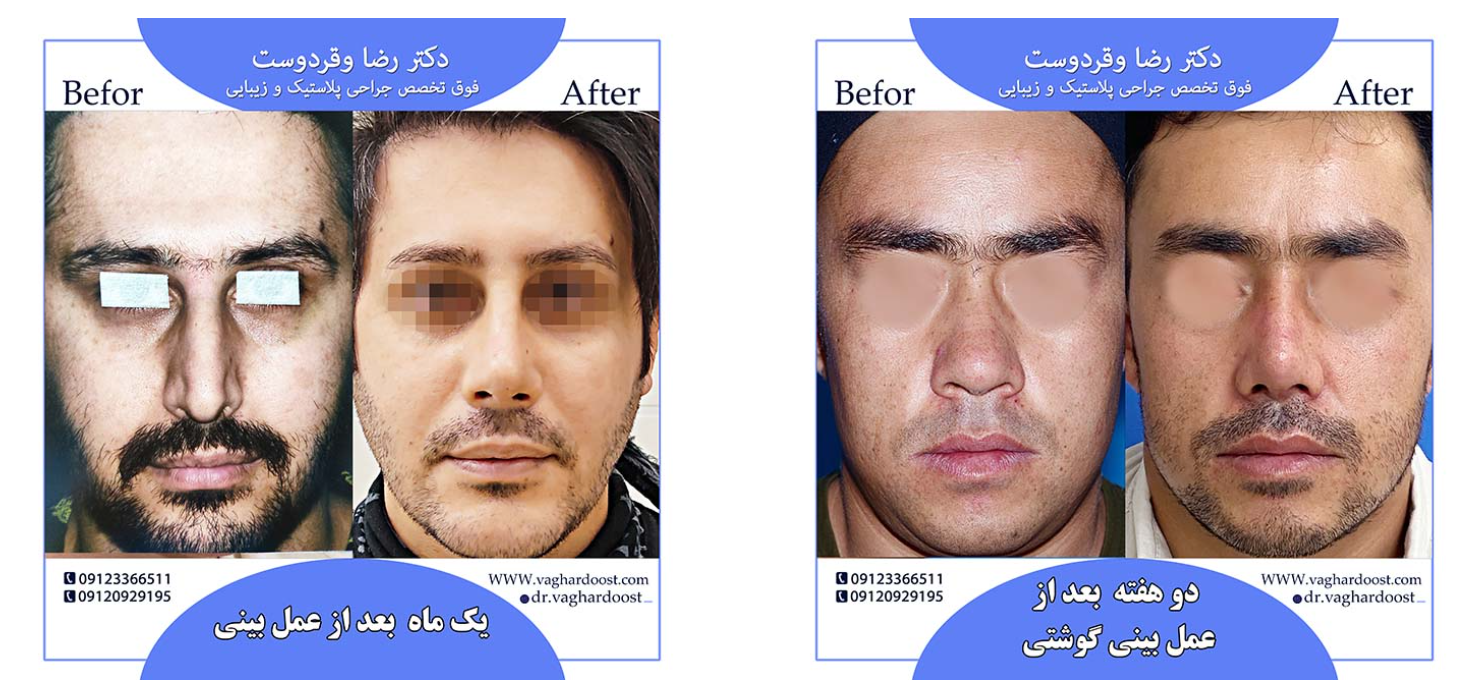جراحی بینی/ همه چیز درباره عمل بینی