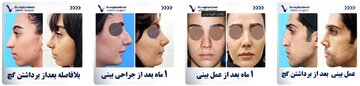 جراحی بینی/ همه چیز درباره عمل بینی