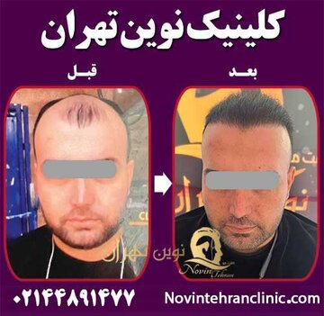 برای کاشت مو به کدام کلینیک مراجعه کنیم
