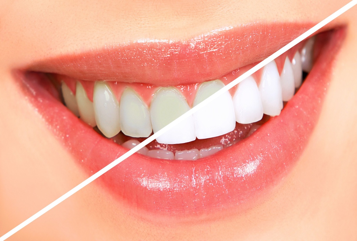 آشنایی با ایمپلنت، بلیچینگ و لمینت دندان/ لمینت دندان، بلیچینگ و ایمپلنت چه کاربردی دارند؟