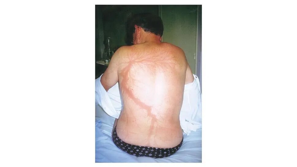 برخورد صاعقه چه بلایی سر بدن انسان میآورد؟/ عکس