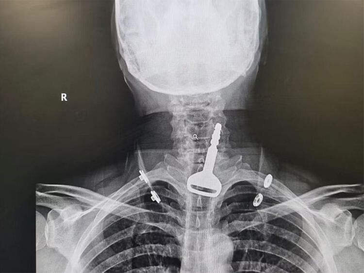 تا یک قدمی مرگ با بلعیدن سوئیچ خودرو/ عکس