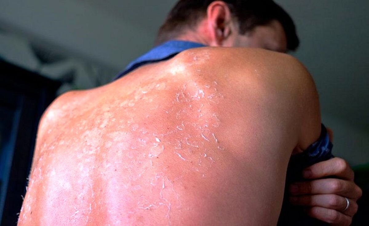 آیا آفتابسوختگی همان مسمومیت با نور خورشید است؟