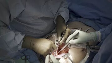 ابراز نگرانی معاون وزیر بهداشت از بیاقبالی نسبت به چند رشته مهم جراحی در ایران / اسامی رشتهها