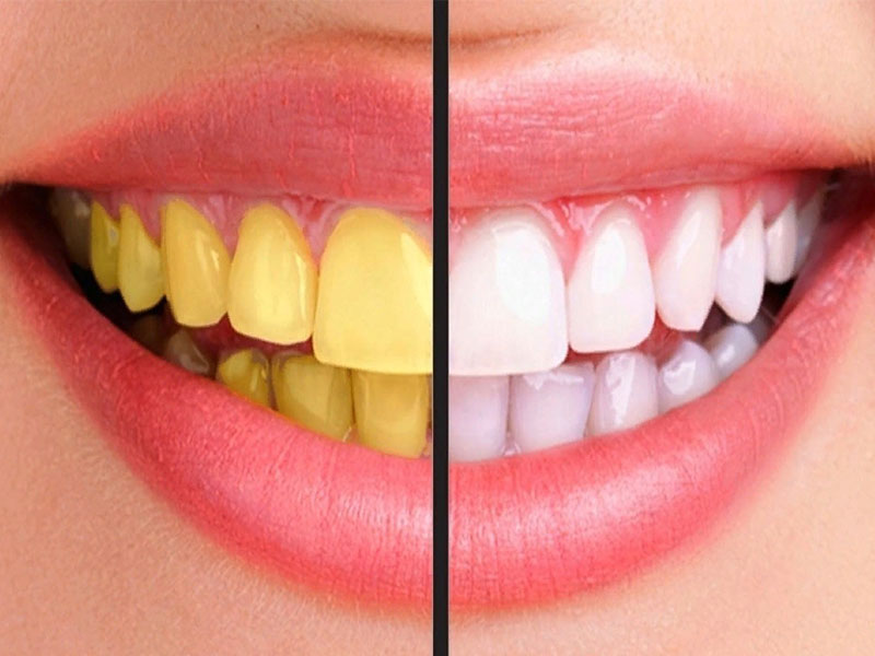 بهترین روش های سفید کردن دندان ها