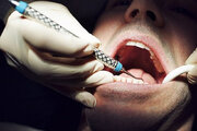 ببینید | ویدیویی پربازدید از ابتکار دندانپزشک وطنی؛ درست کردن دندان شخصی!