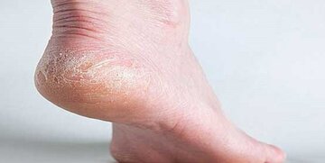 ترک پاشنه پا در اثر کمبود این ۳ ویتامین ایجاد میشود ترک پاشنه پا در اثر کمبود این ۳ ویتامین ایجاد میشود