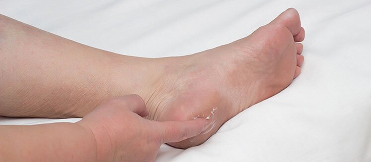 علت ایجاد « خار پاشنه » چیست و چگونه درمان میشود؟