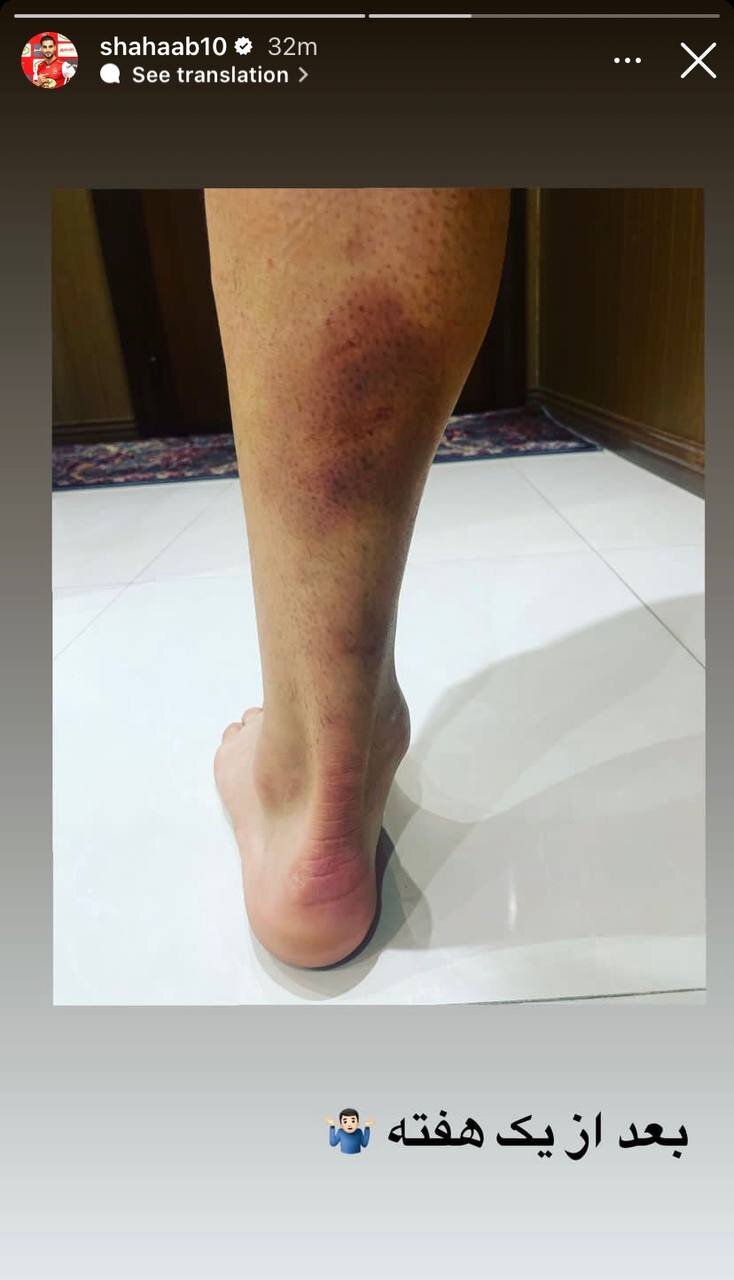 عکس| اعتراض خلاقانه یک پرسپولیسی؛ رونمایی از تصویر کبودی پا و لحظه پنالتی!