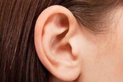 ببینید | آیا گوش بلبلی نیاز به اتوپلاستی دارد؟