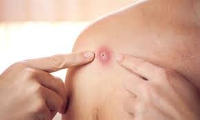 «کورک» چیست و چرا به وجود میآید؟/ روش های درمان