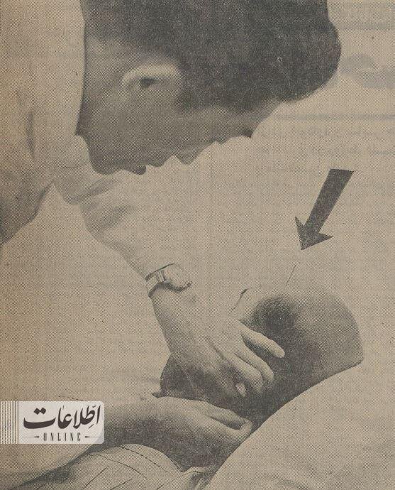 اولین مشتری طبسوزنی در ایران که بود؟/ عکس