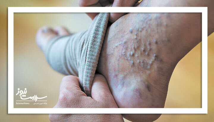 واریس چیست و چگونه درمان میشود؟/ هر آنچه در مورد واریس باید بدانید