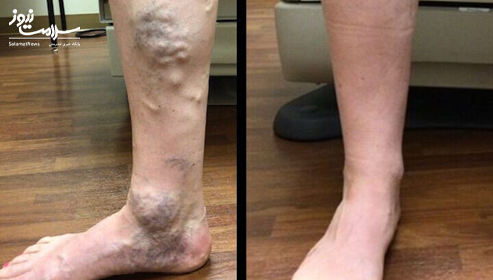 واریس چیست و چگونه درمان میشود؟/ هر آنچه در مورد واریس باید بدانید