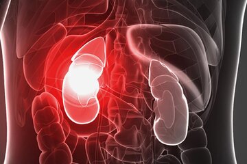 خطر ابتلا به سنگ کلیه با انجام این ۸ مورد خطر ابتلا به سنگ کلیه با انجام این ۸ مورد