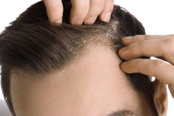 ۵ عامل موثر در افزایش شوره سر ۵ عامل موثر در افزایش شوره سر