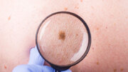 کدام سرطان پوستی خطرناک‌تر است؟