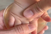 ببینید | ویدئویی ترسناک از دورهمی باکتری‌ها در کف دست یک کودک