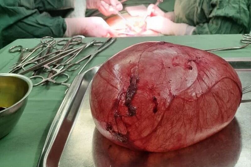 خارج کردن توده ۴ کیلوگرمی از شکم دختر ۱۸ ساله/ عکس