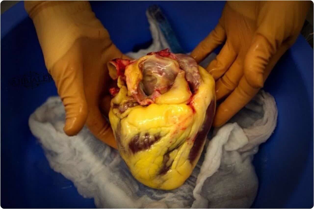 عکس | تصویری باورنکردنی از قلبِ شخصِ چاق فوت شده در اثر سکته قلبی