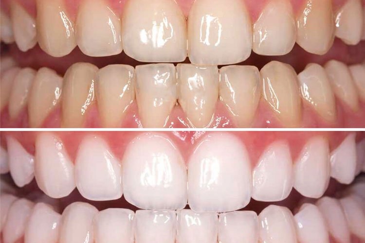روش های موثر خانگی سفید کردن دندان