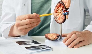 برای درمان سنگ کلیه چه بخوریم؟ برای درمان سنگ کلیه چه بخوریم؟