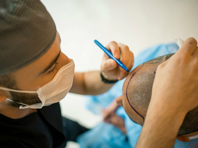 کاشت موی موفق در کلینیک کاشت موی ایران فیت