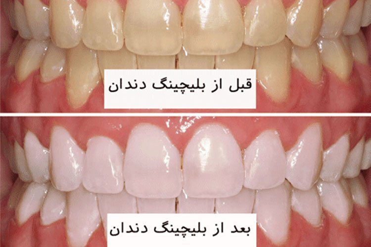 عوارض بلیچینگ دندان| آیا سفید کردن دندان ضرر دارد؟