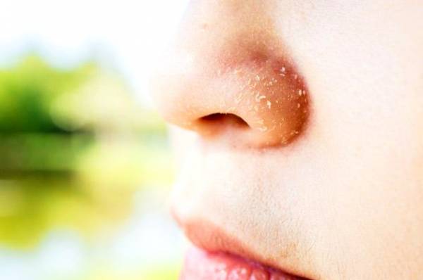 علت پوسته پوسته شدن روی بینی چیست؟