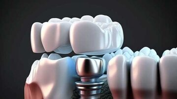 قبل از جراحی ایمپلنت دندان چه مواردی را رعایت کنیم؟