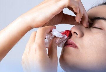 چرا در تابستان خوندماغ میشویم؟/ پیشگیری و راه درمان چرا در تابستان خوندماغ میشویم؟/ پیشگیری و راه درمان