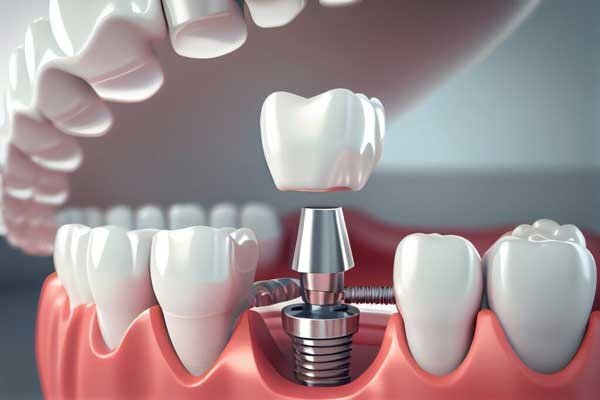 قبل از جراحی ایمپلنت دندان چه مواردی را رعایت کنیم؟