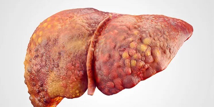 با این میوهها کبد چرب بهبود مییابد