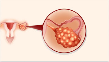 تنبلی تخمدان خطر مرگ در سنین پایین را افزایش می‌دهد