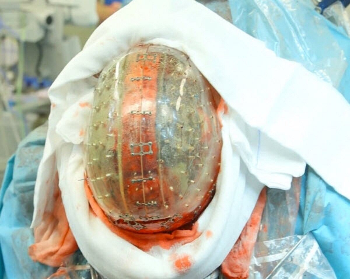 جمجمه مصنوعی جان پسربچه را نجات داد/عکس