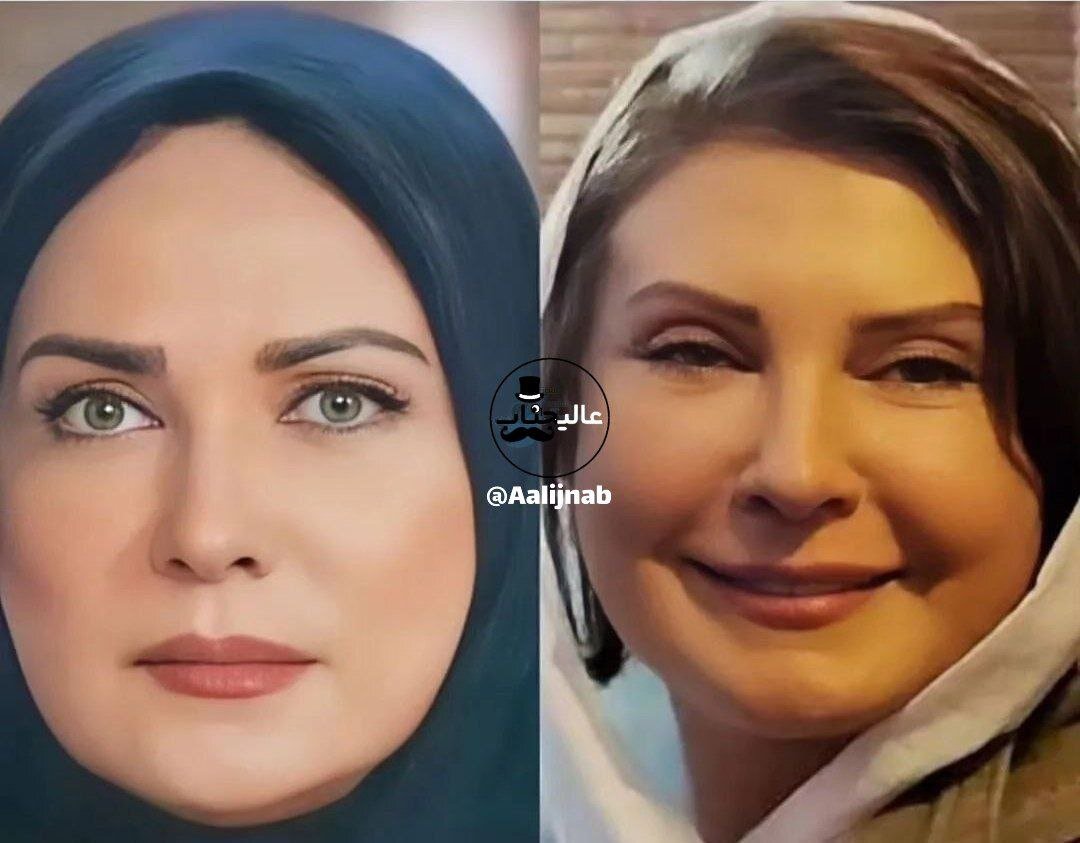 عکس | چهره شوکهکننده لعیا زنگنه بعد از عمل جراحی زیبایی