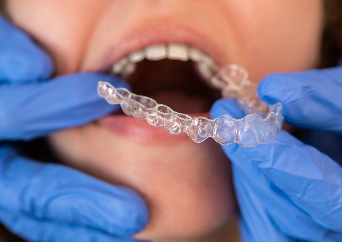 انوع ارتودنسی نامرئی کدام است؟