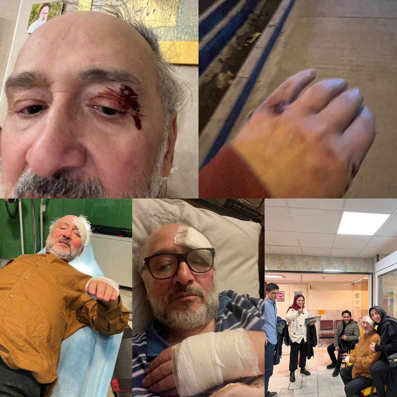 حمله دزدان به محمدعلی ابطحی برای دزدیدن موبایلش/ ۱۰ بخیه روی ابرو و ترک خوردن قفسه سینه!+ عکس