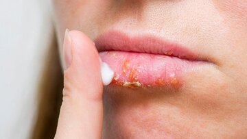 ۴ دلیل ترک خوردن لبها/ روشهای درمان ۴ دلیل ترک خوردن لبها/ روشهای درمان