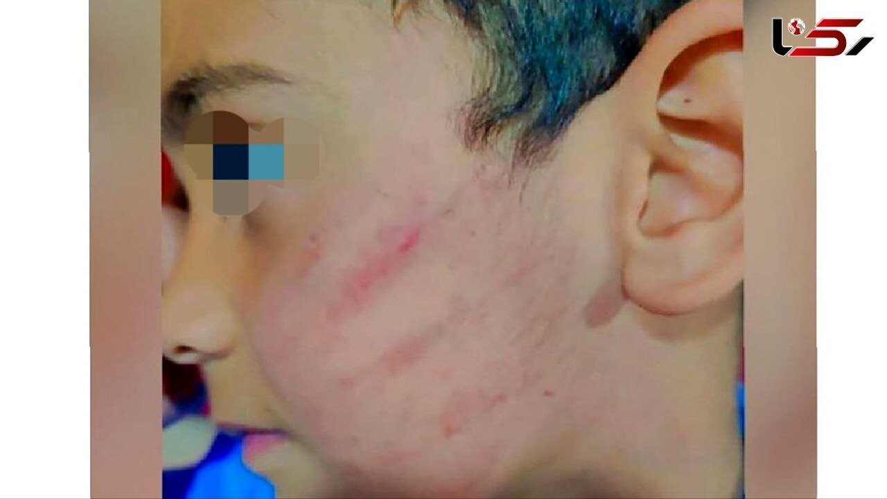 تصویر صورت کتک‌خورده یک دانش آموز اول دبستانی خبرساز شد