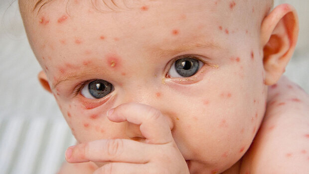 همهچیز در مورد یک ویروس بهاری؛ بیشتر مراقب کودکان خود باشید