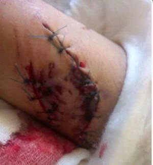 تصاویر دلخراش از حمله سگهای ولگرد به یک دختر دانشآموز | عکس