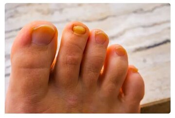 سندرم ناخن زرد چیست؟ سندرم ناخن زرد چیست؟