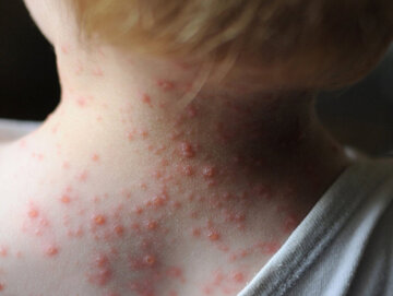 ۲ دلیل مهمِ افزایش آمار آبله مرغان در ایران/ کدام کودکان آبله مرغان نمیگیرند؟ ۲ دلیل مهمِ افزایش آمار آبله مرغان در ایران/ کدام کودکان آبله مرغان نمیگیرند؟