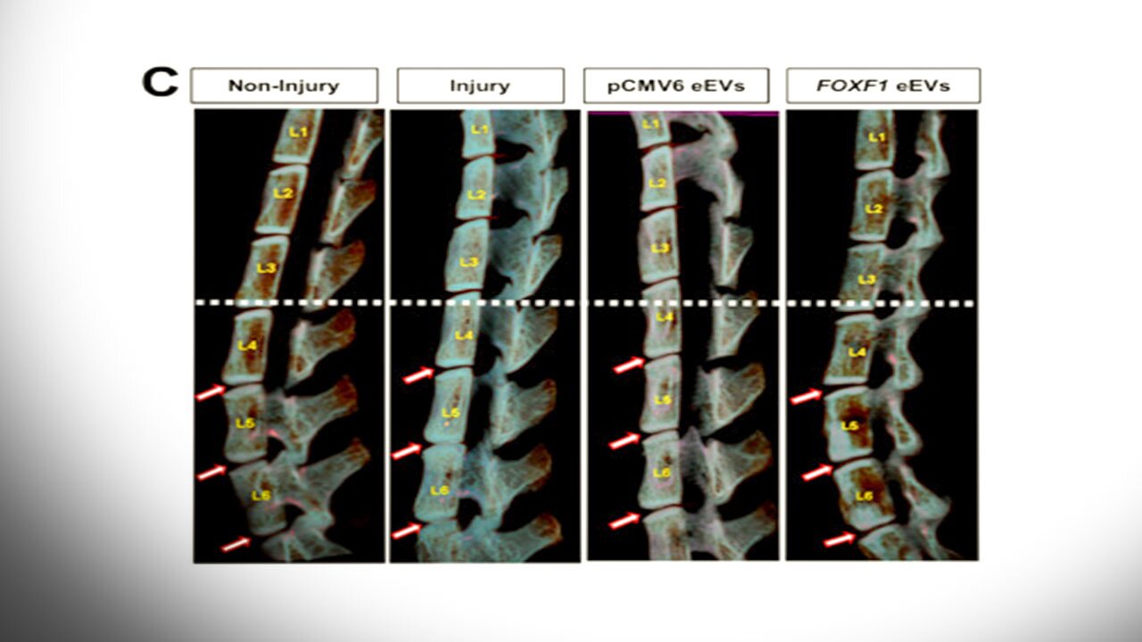 خبر خوب برای مبتلایان به دیسک کمر