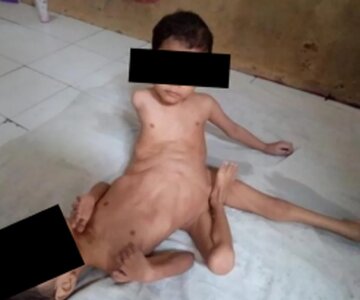 تصاویر باورنکردنی از دوقلوهایی با سه پا و چهار دست تصاویر باورنکردنی از دوقلوهایی با سه پا و چهار دست