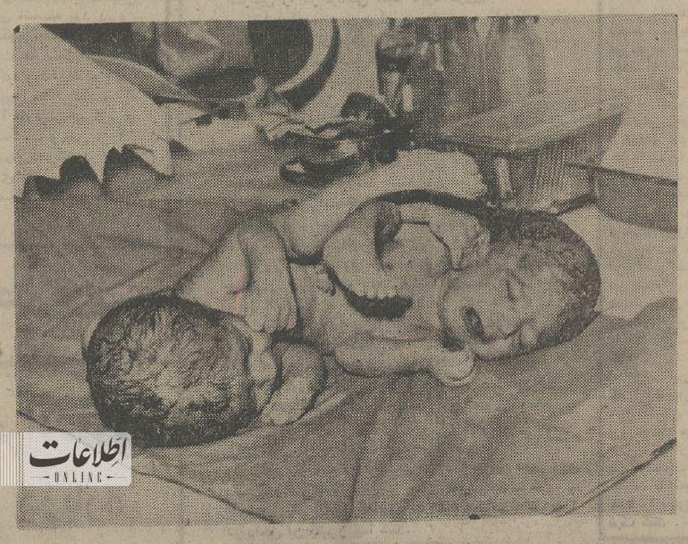 تولد عجیب یک نوزاد با دو سر و چند دست و پای اضافی در نیشابور، ۵۰ سال قبل/ عکس