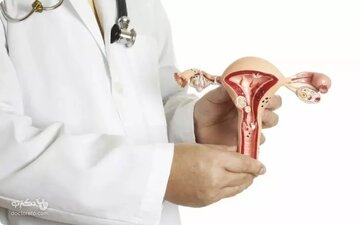 انجام عمل دشوار تخلیه کیست تخمدان خونریزی دهنده با روش جراحی بسته انجام عمل دشوار تخلیه کیست تخمدان خونریزی دهنده با روش جراحی بسته